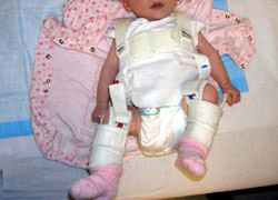 Pavlik Harness used for children with hip dysplasia up to 6 months old.