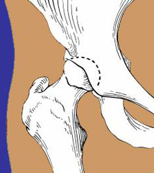 Line drawing of a healthy hip joint with no signs of dysplasia