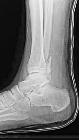 compression fracture leg