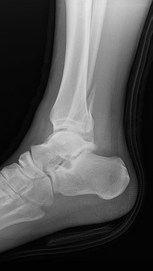 hairline fracture in foot symptoms