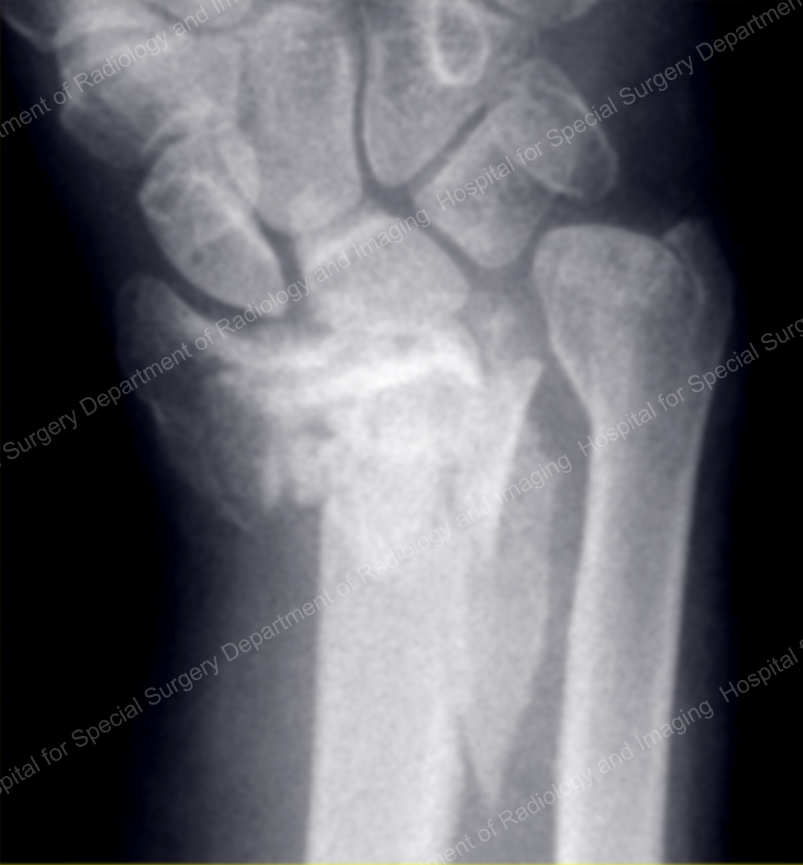 X-ray image showing a complex fracture of the distal radius.