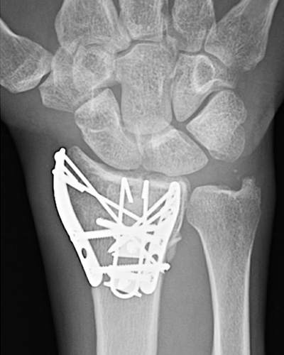 Complex fragment-specific internal fixation for surgical treatment of a severe distal radius fracture.