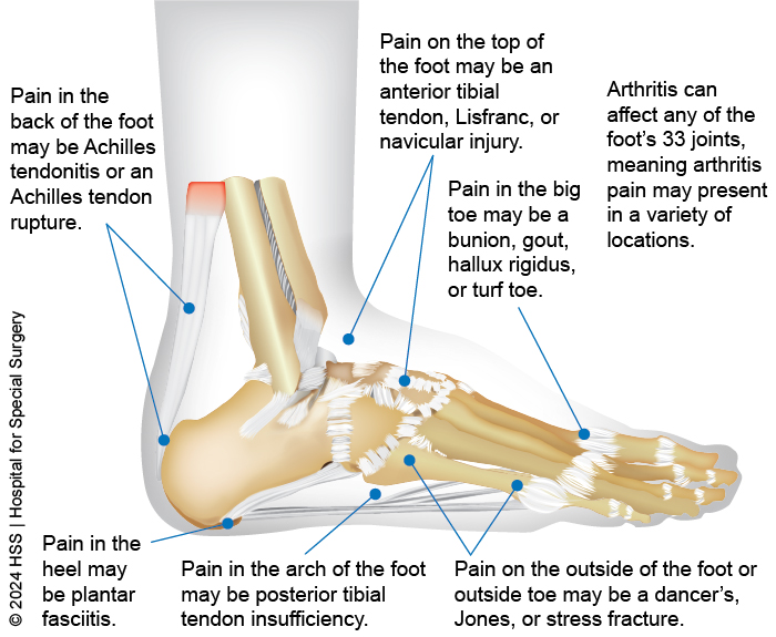 Children's Heel Pain | Sierra Foot & Ankle Clinic - Carson City, NV