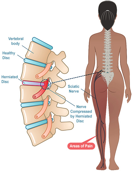 Lumbar Disc Herniation: Frequently Asked Questions | HSS Spine