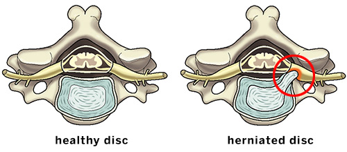 Herniated Disc (Slipped Disc) - Orchard Health Clinic - Osteopathy
