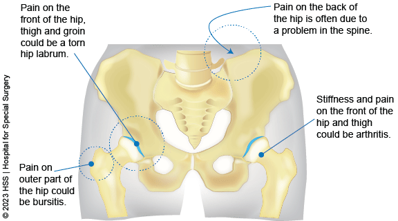 https://www.hss.edu/images/articles/hip-pain-location-diagram.png