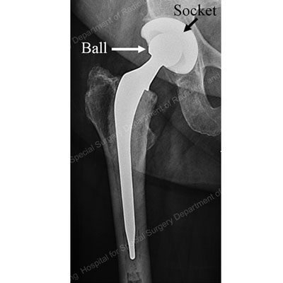 Total Hip Replacement Before & After Photos