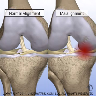 misaligned knee joint