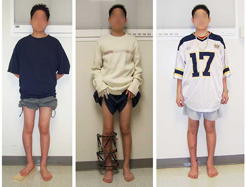 Images of pediatric patients (1) with different leg lengths for surgery, (2) with external fixator for leg extension, (3) with equal leg lengths after surgery. &amp; lt; pran &amp; gt; Find out more about all the different criteria that are likely to cause leg length differences.
