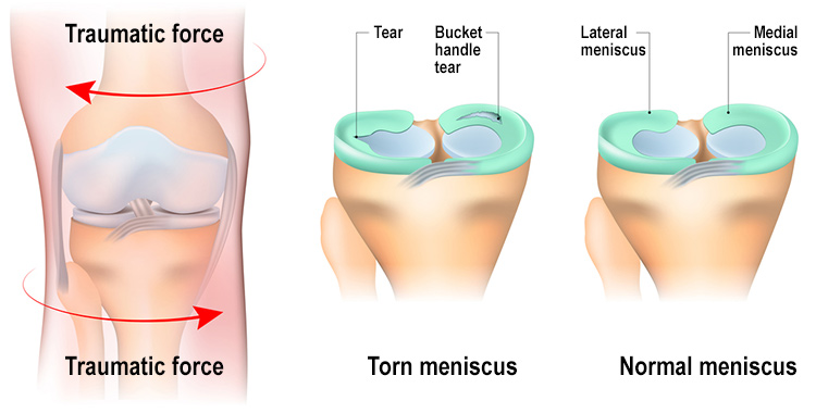 The mechanics of a meniscus tear.