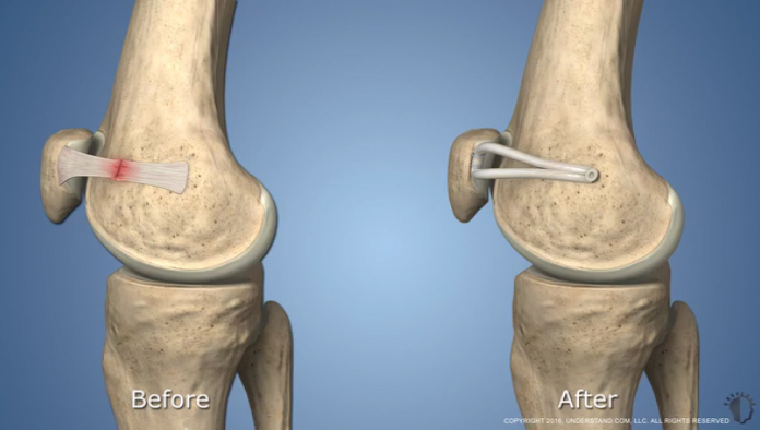 Medial Collateral Ligament (MCL) Tear Reconstruction – Dr Mukhi's