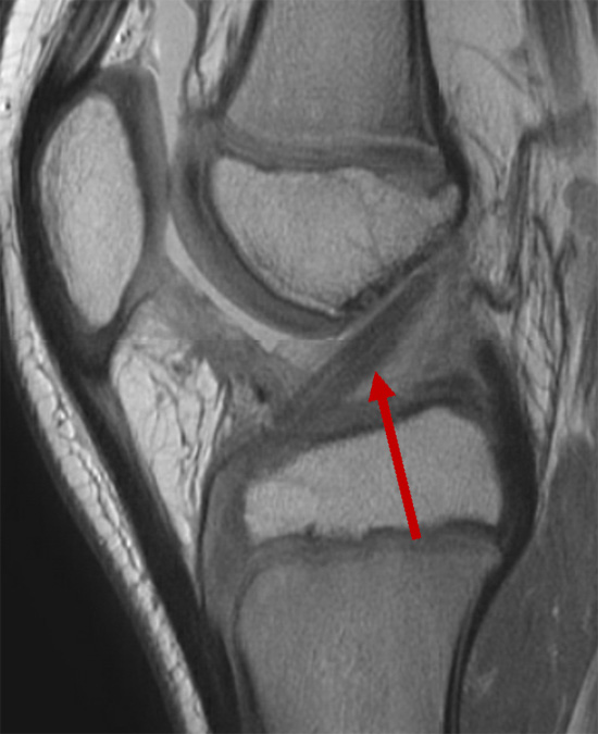 MRI showing a reconstructed ligament after ACL surgery.