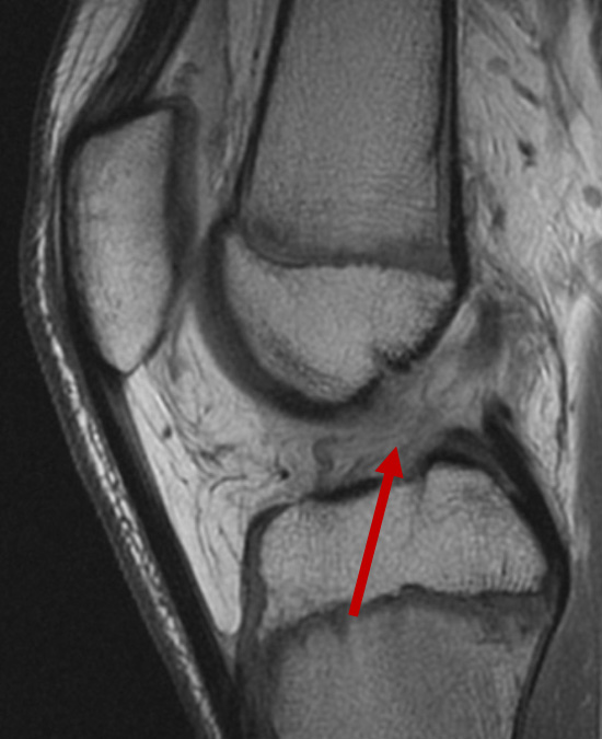 MRI showing a completely torn ACL.