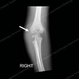 elbow humerus fracture
