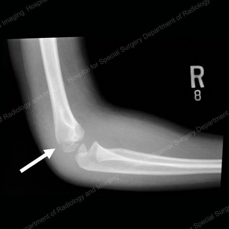 elbow x ray fracture