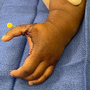 A child's hand, palm down, after pollicization surgery.