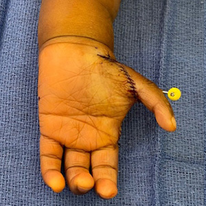 A child's hand, palm up, after pollicization surgery.