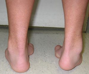 abnormal toe growth