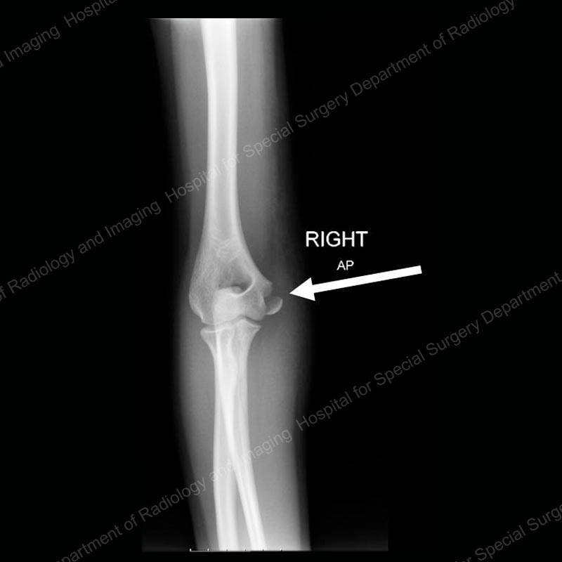 elbow x ray fracture