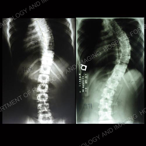 lumbar scoliosis x ray