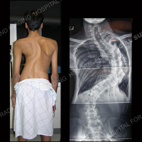 Scoliosis In Adults What To Know About Symptoms And Treatment