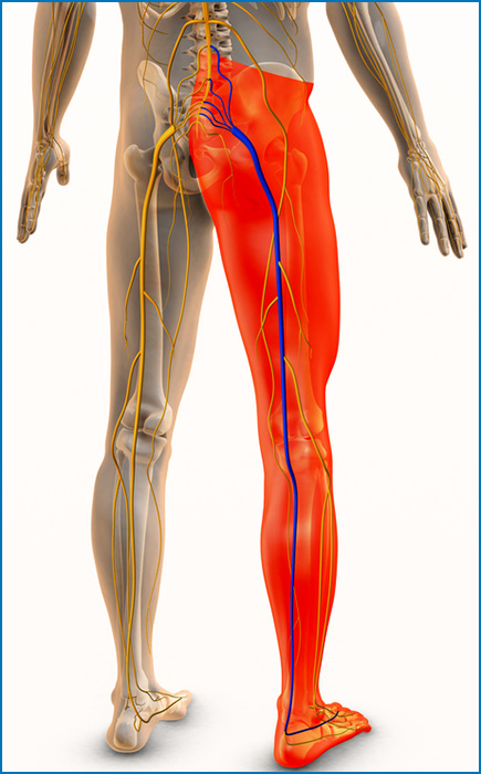 Illustration of the sciatic nerve and area of sciatica pain symptoms.