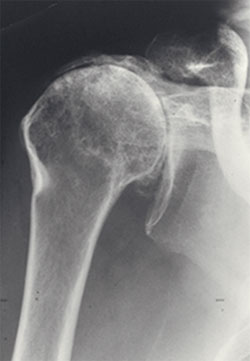 https://www.hss.edu/images/articles/shoulder-arthritis-cuff-tear-arthropathy-arthritis-xray-slide6.jpg