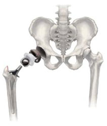 Arthritis of the Hip - Total Hip Replacement and Treatments - HSS