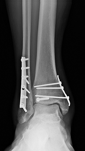 trimalleolar ankle fracture recovery