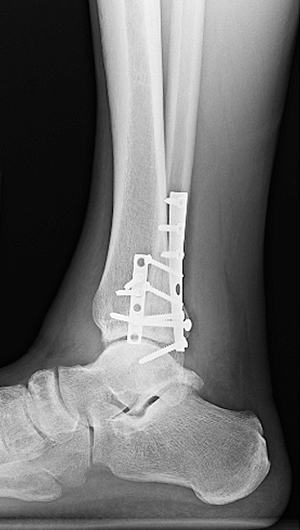 Ankle fracture: diagnosis and therapy