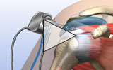 Rotator Cuff Surgery: How it Works, Recovery Time