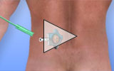 view lower lumbar discectomy animation