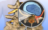 Spine Surgery: Minimally Invasive Lumbar Discectomy / Percutaneous Disc ...