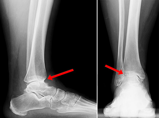 Ankle Replacement Surgery: How It Works, Recovery Time