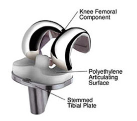 Total Knee Replacement Implant 1 