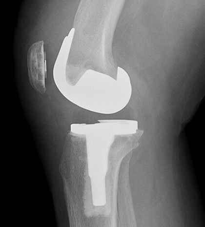 Lateral (side-view) X-ray of total knee replacement implants.