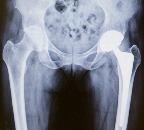 Total Hip Replacement Surgery Video, Hip Orthopaedics Videos