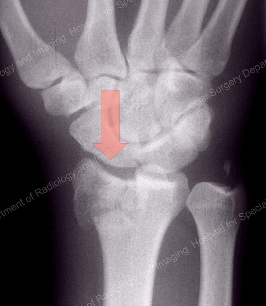 hairline fracture wrist xray