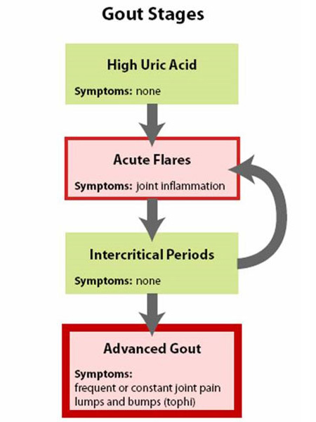 Gout Stages illustration from an article about Gout written by Theodore R. Fields, MD, FACP from Hospital for Special Surgery