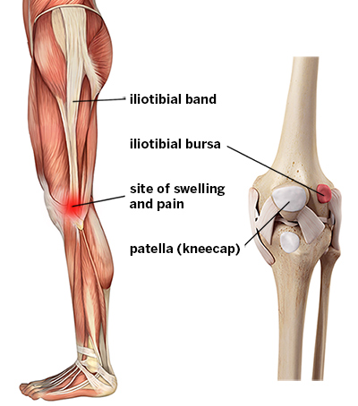 IT Band Syndrome: Knee Pain Symptoms & Treatments