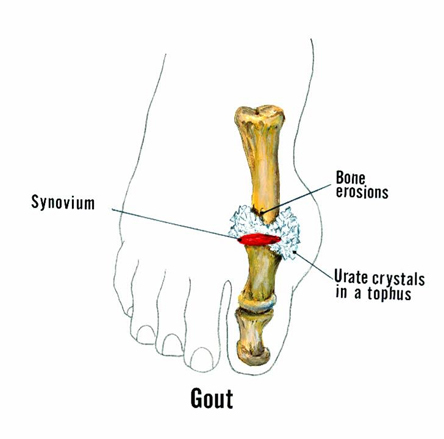 Ilustrație a unui deget de la picior cu tof cu gută