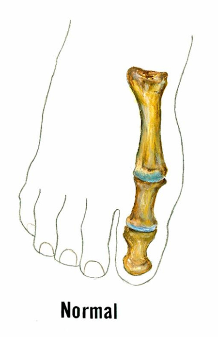 Illustration d'un orteil normal