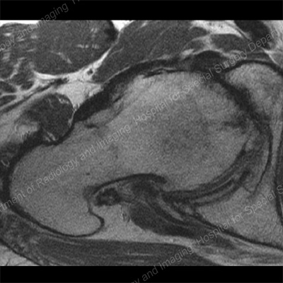 MRI che mostra un restringimento dell'articolazione anteriore e osteofiti dovuti all'osteoartrite