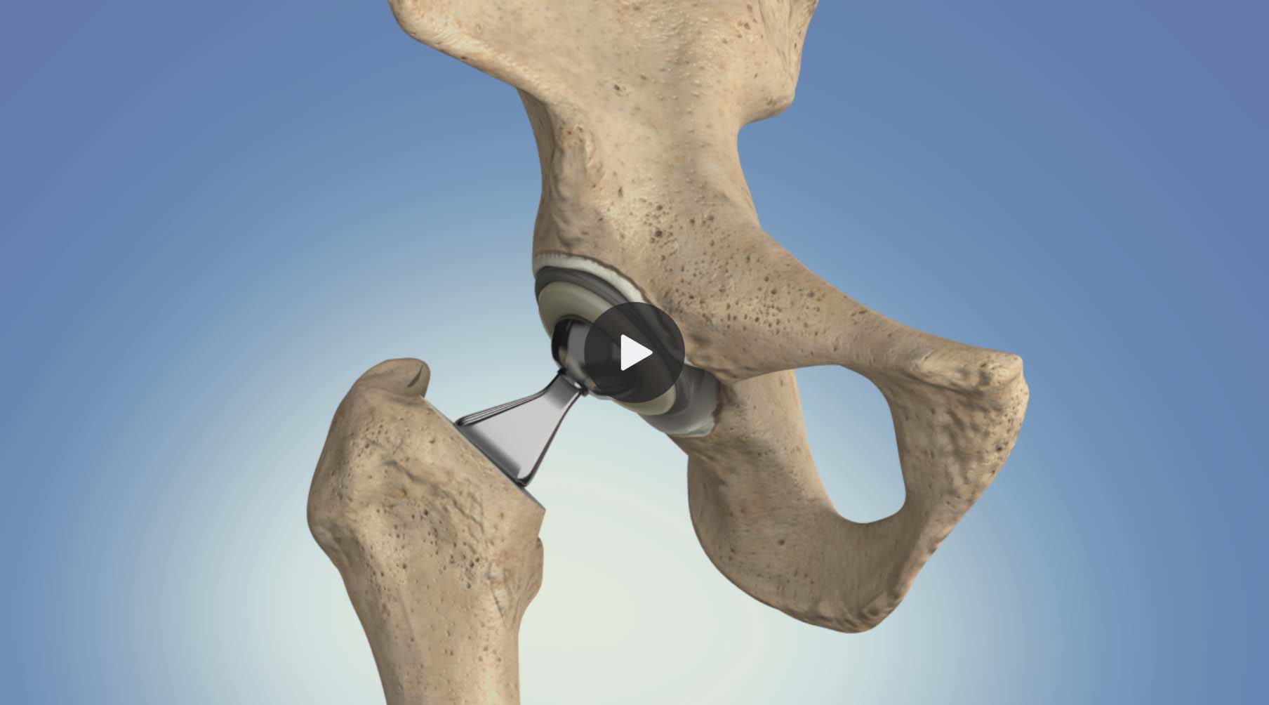 Hip Replacement Surgery How It Works Recovery Time HSS