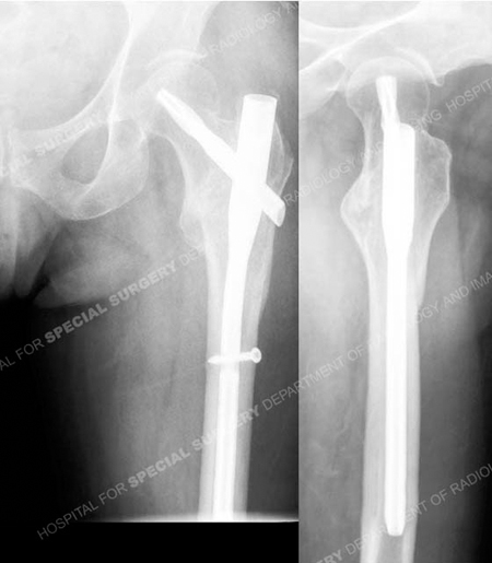 Radiographs 6 months following fracture surgery illustrating a healed intertrochateric hip fracture from a case example from the Orthopedic Trauma Service at Hospital for Special Surgery.