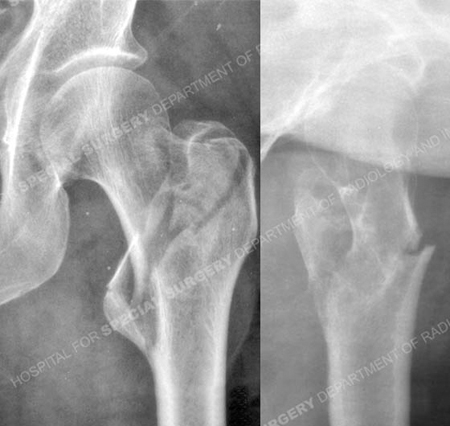 Could You Have a Hip Fracture and Not Know It?: Tuscaloosa