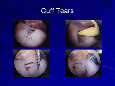 When Do Rotator Cuff Tears Fail After Surgical Repair?, Arthroscopic  Surgery