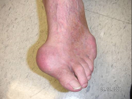 Photo of a toe with an acute attack of Gout