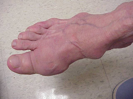 Photo showing tophi on a foot