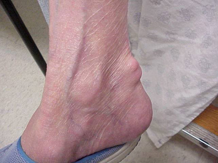 can gout cause ankle swelling